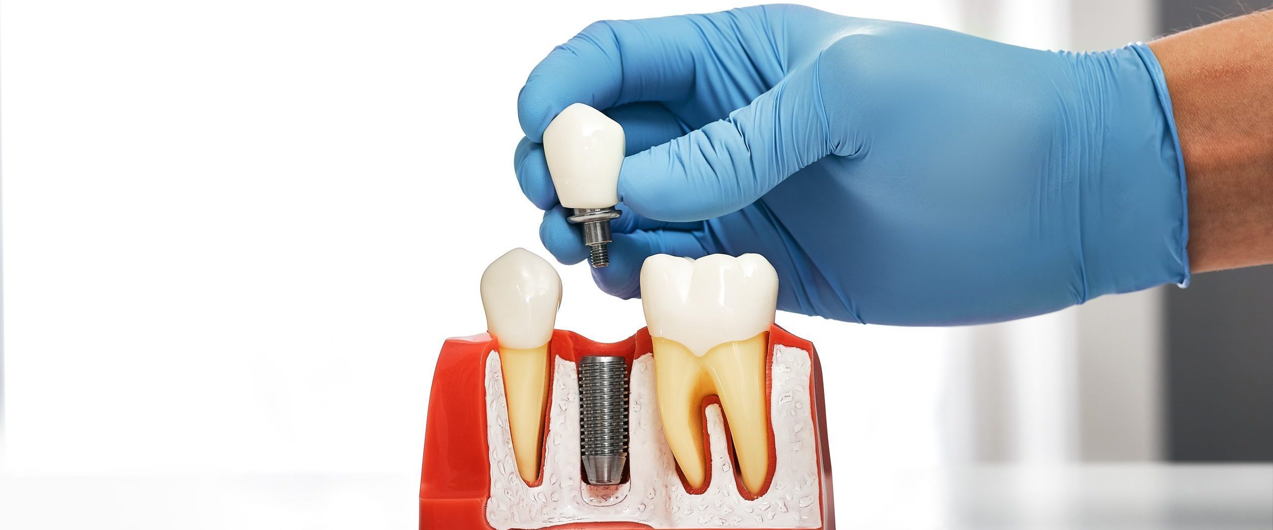 Dentist showing the installation of a dental implant on the anatomical model of teeth, close-up. Process of installing a dental implant