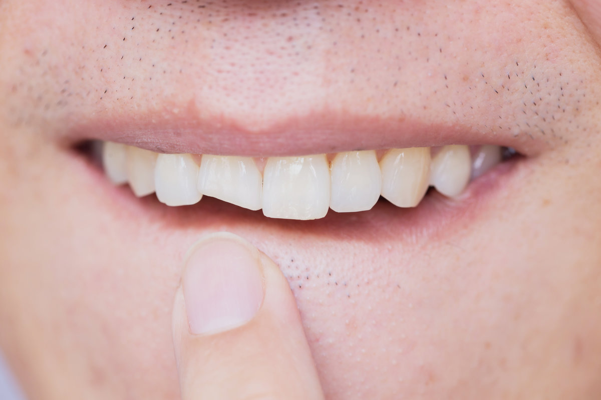 Male broken teeth damaged cracked front tooth need dentist to fix and repair.