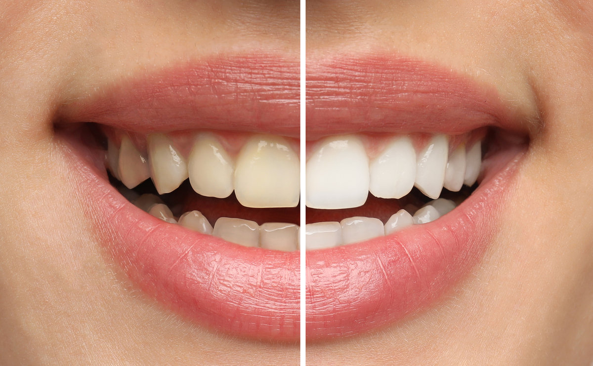 Before and after teeth whitening results