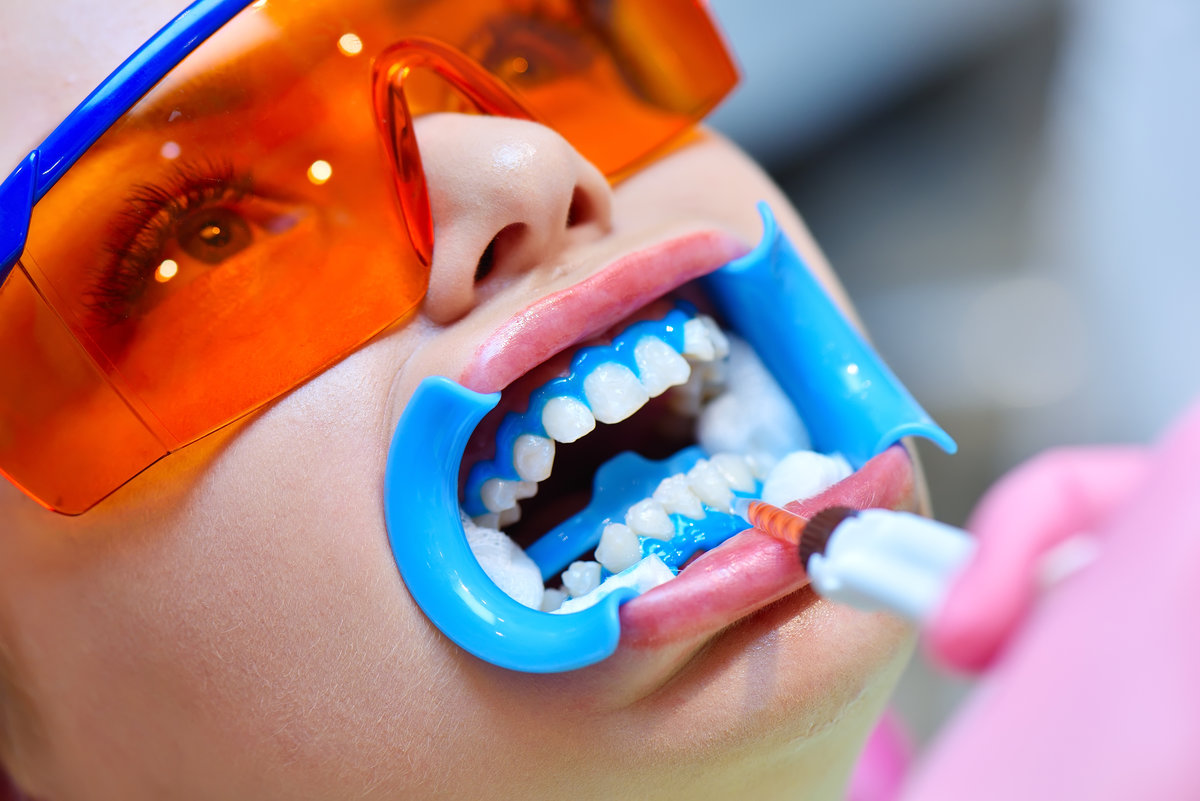 Dentist applies gel to teeth before teeth whitening procedure. Beautiful girl in safety glasses. Dental And Teeth Whitening Concept.