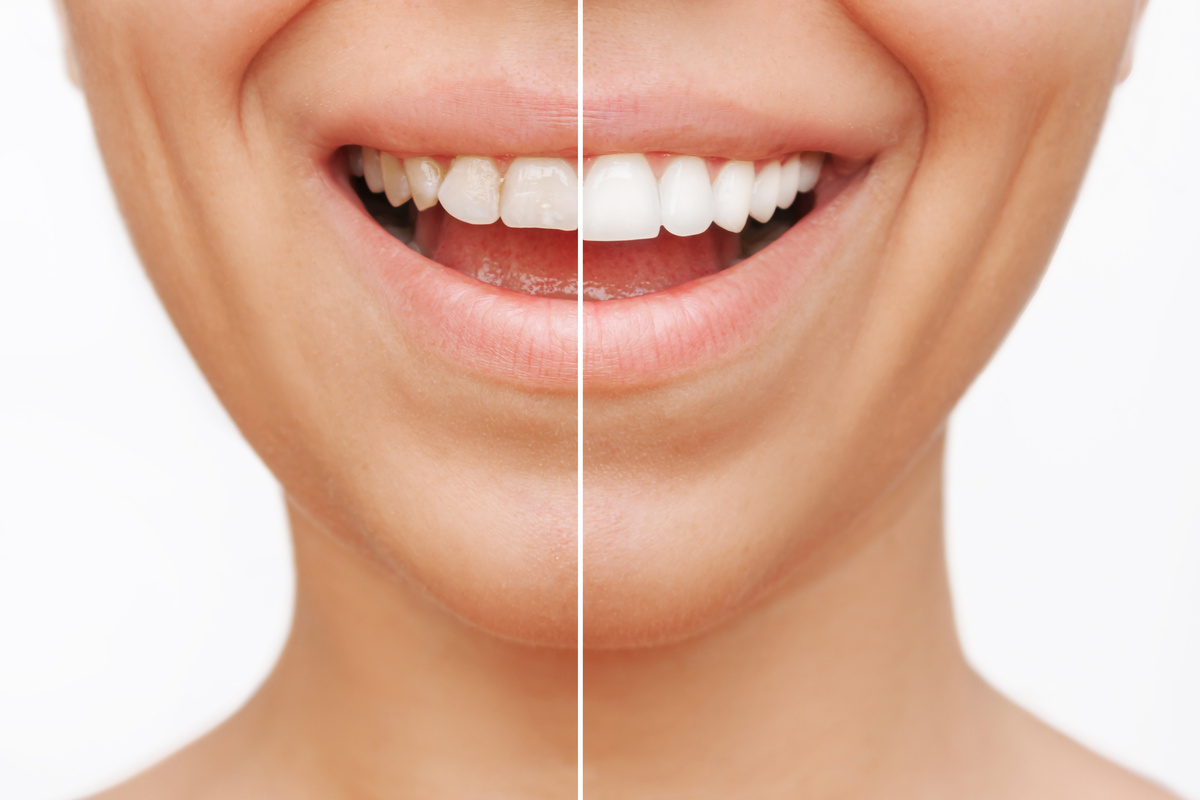 Smile transformation before and after dental veneers