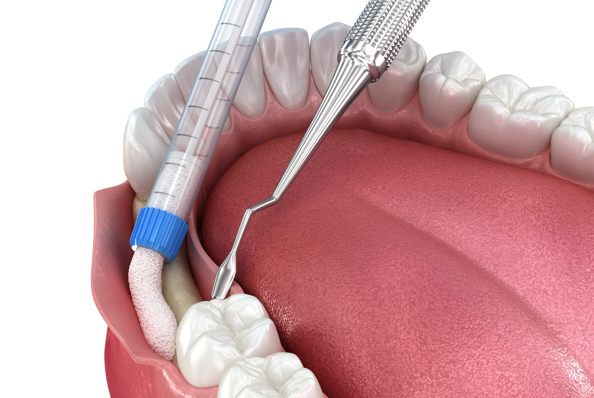 Bone grafting augmentation for tooth implantation. Medically accurate 3D illustration.