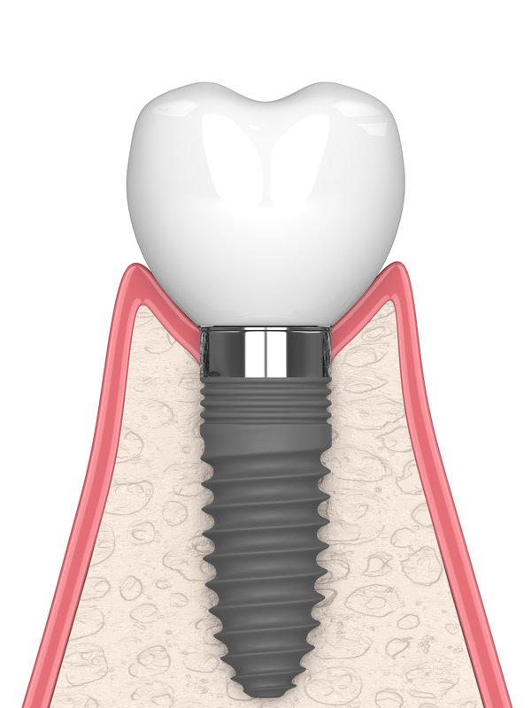 3d render of gum cross-secton with implant placement over white background