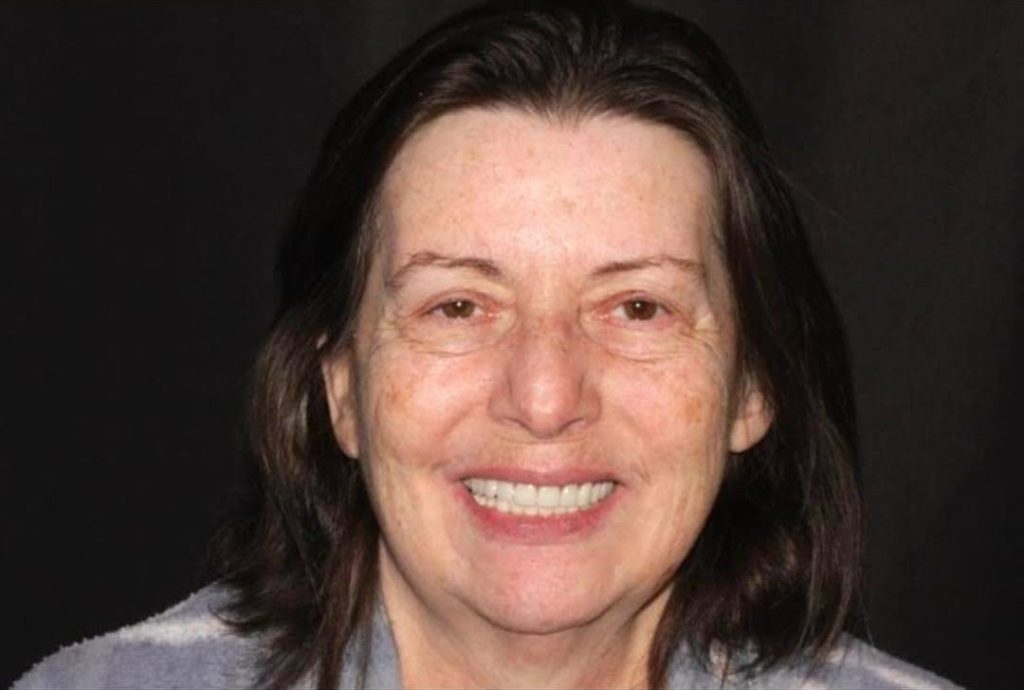 Middle-aged woman with dark hair smiling, displaying straight white teeth after dental work