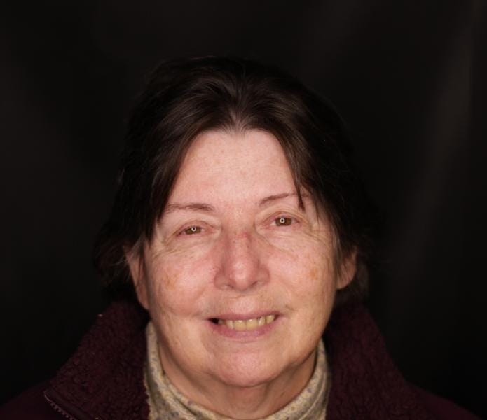 Before single tooth dental implant treatment - Evergreen Grace Dental Care Renton WA