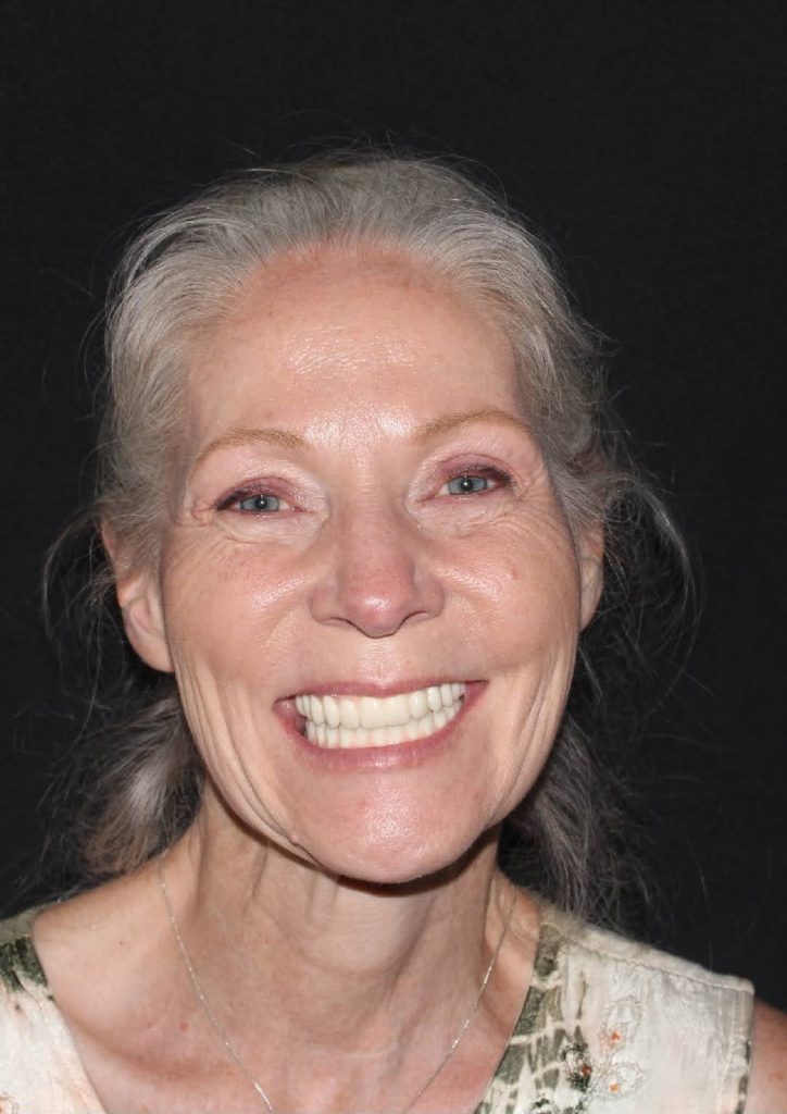 Older woman with gray hair smiling, showing bright white teeth after dental treatment