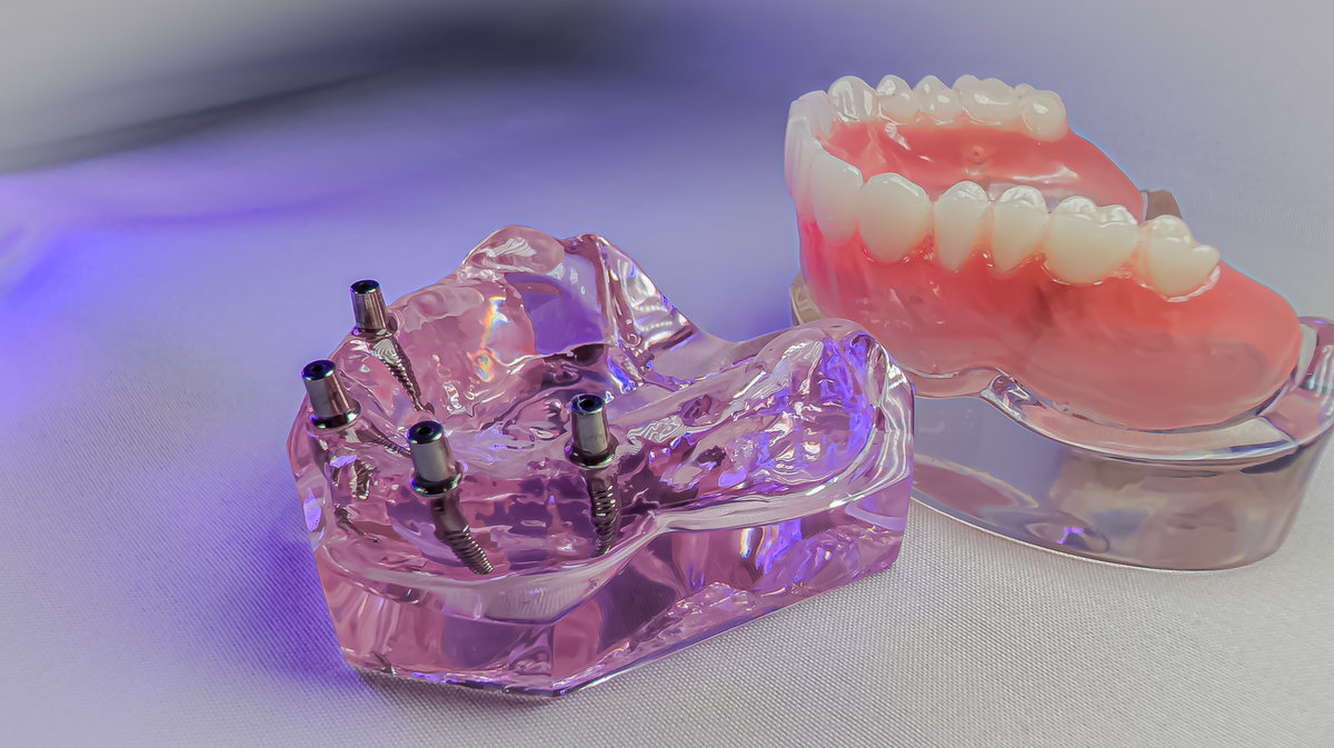Implant model with visible abutments placed on a white surface, with a lower jaw denture in the background, used for educational demonstration of implant-supported prosthetics.