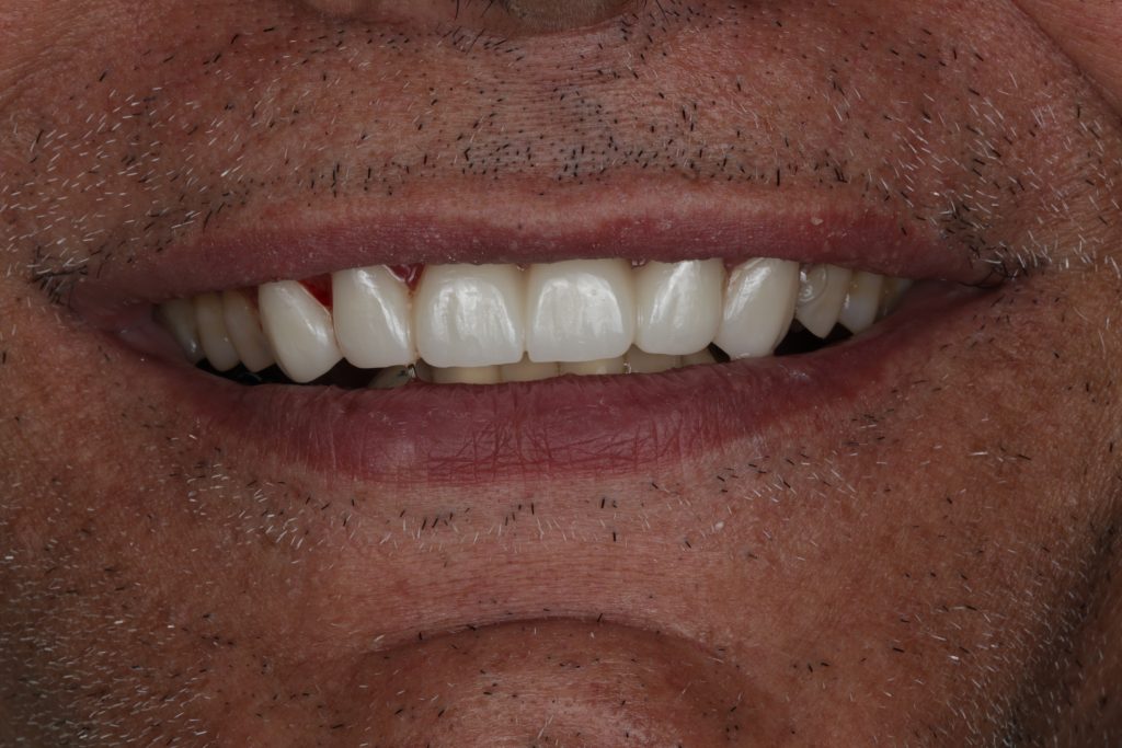 Close-up after crown and bridge restoration at Evergreen Grace Dental Care in Renton, WA