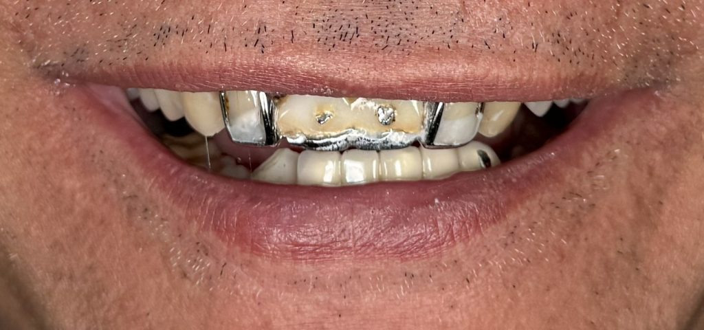 Close-up before crown and bridge restoration at Evergreen Grace Dental Care in Renton, WA